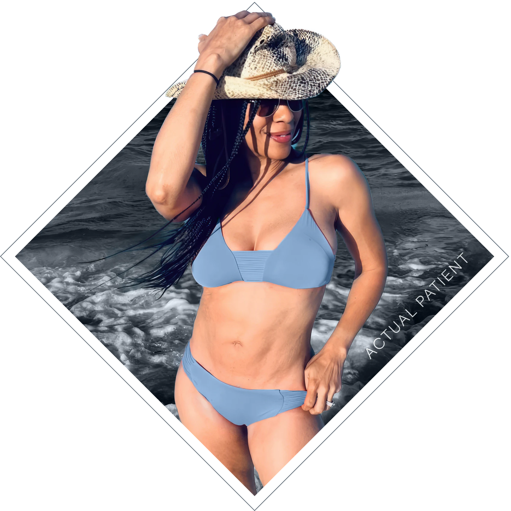 Actual Tummy Tuck Patient