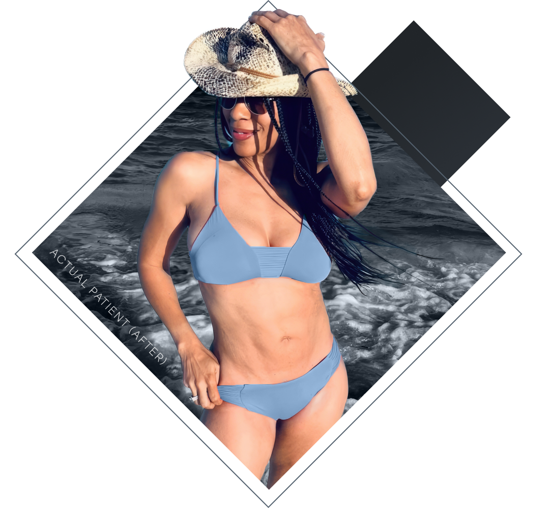Our Houston body contouring patient