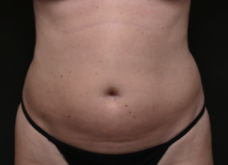 Houston patient before lipo