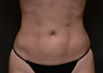 Houston patient after lipo