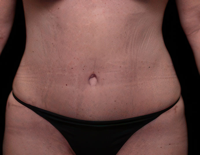 Houston patient after tummy tuck