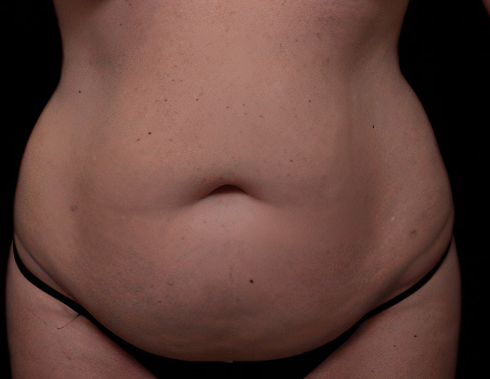 Houston patient before tummy tuck