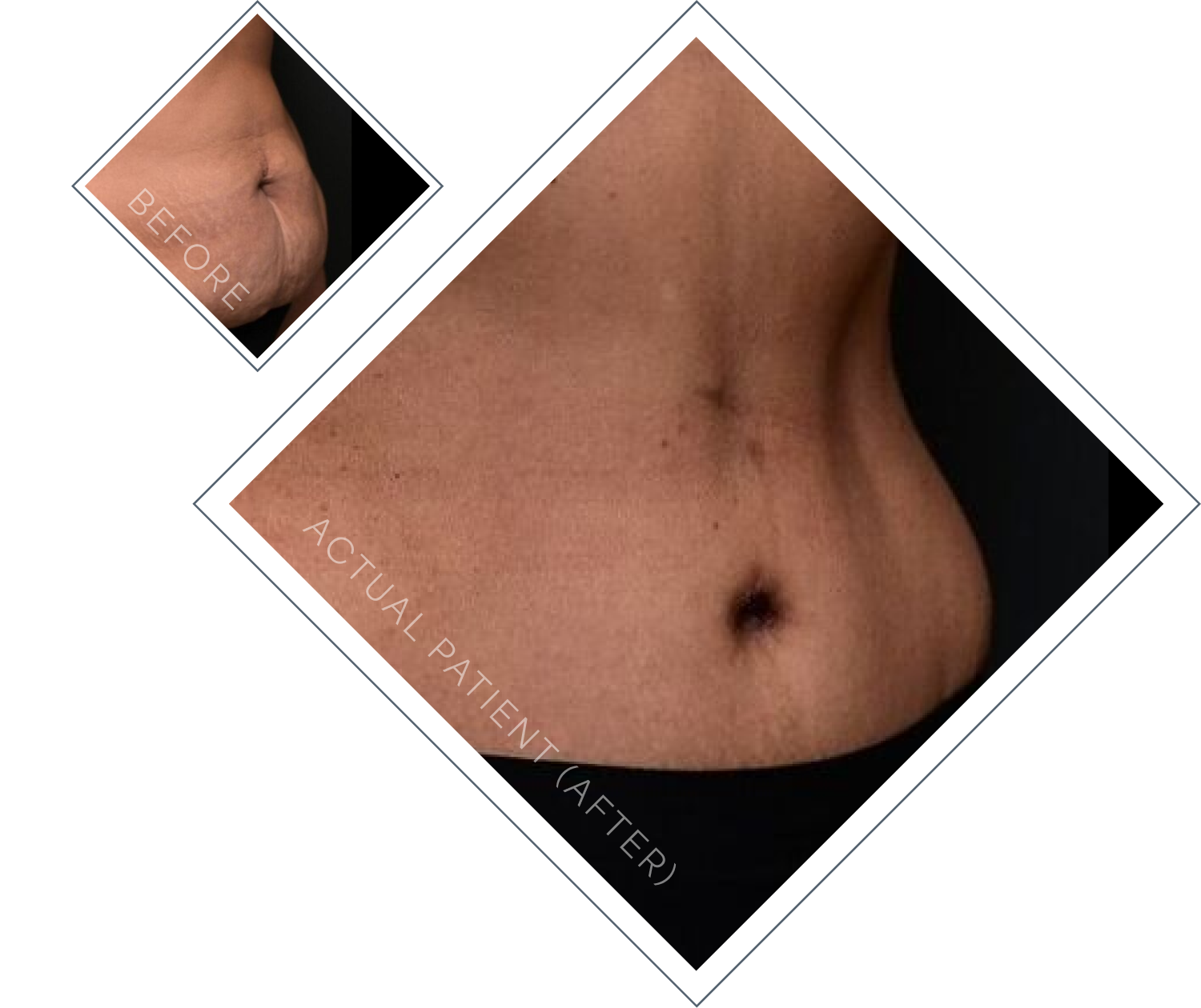 Dr. Linville's tummy tuck patient's results
