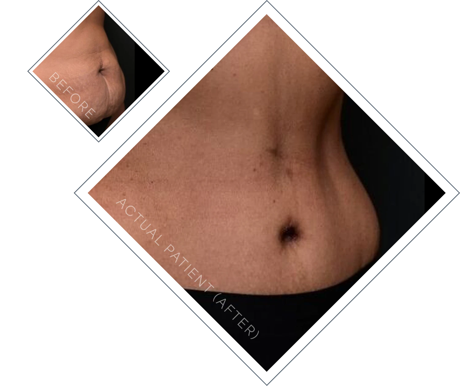 Dr. Linville's tummy tuck patient's results