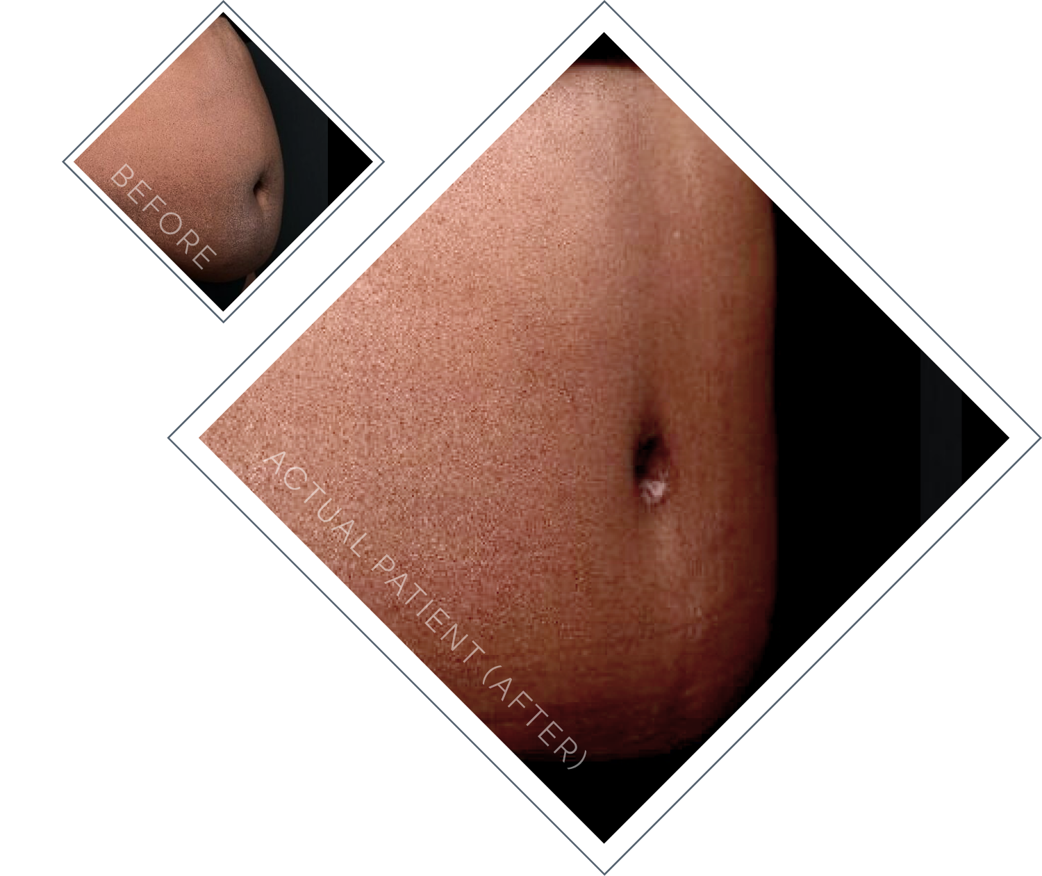Dr. Linville's tummy tuck patient results
