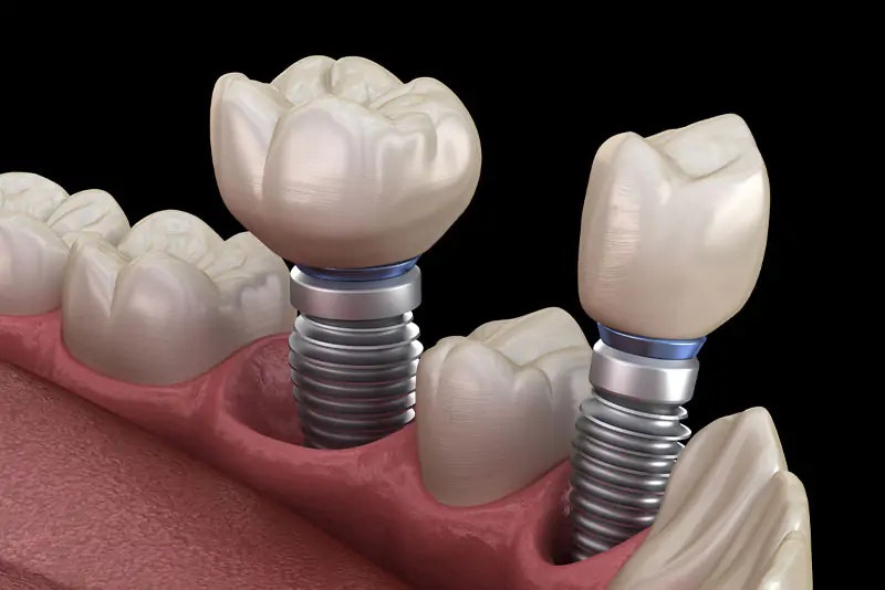 Dental Implants