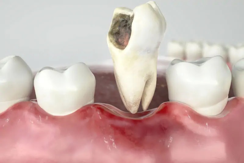 damaged tooth