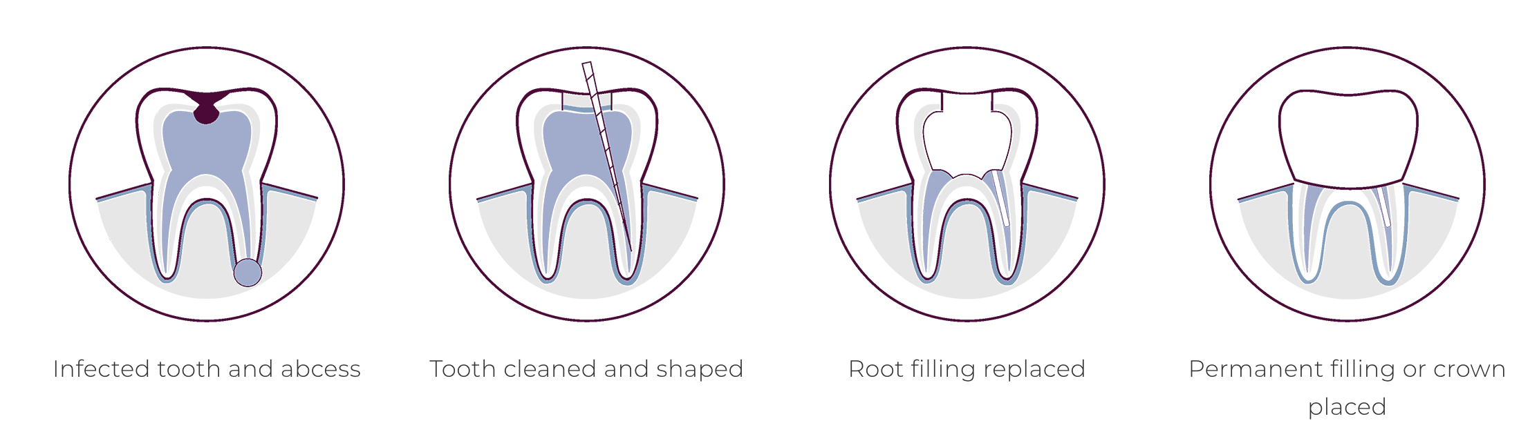 root canal process