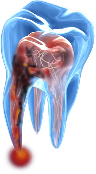 root canal graphics