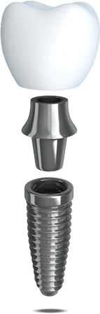 dental implant model