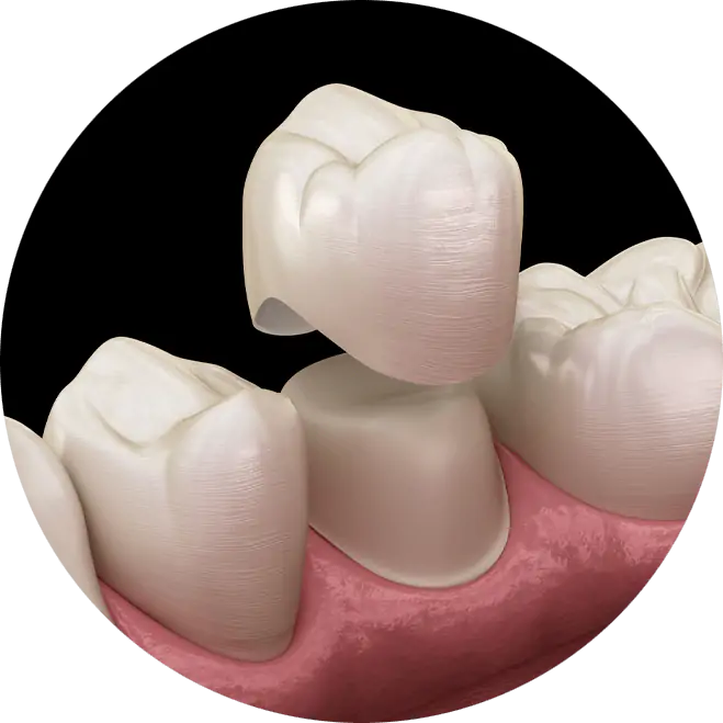 Dental Crown model