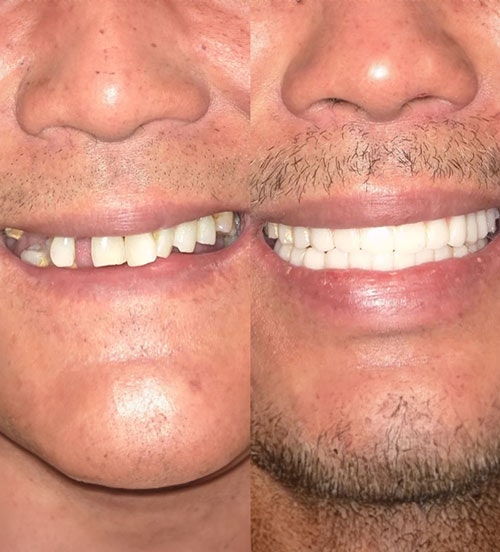 Real patient before and after full arch implants