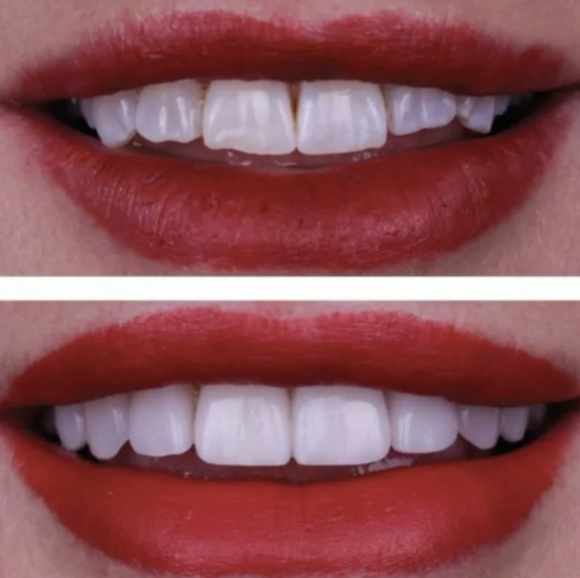 Before and after smile design