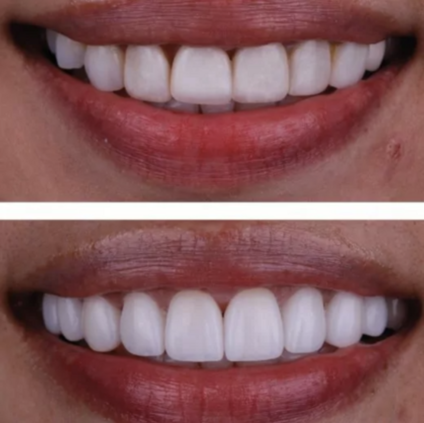 Before and after smile design