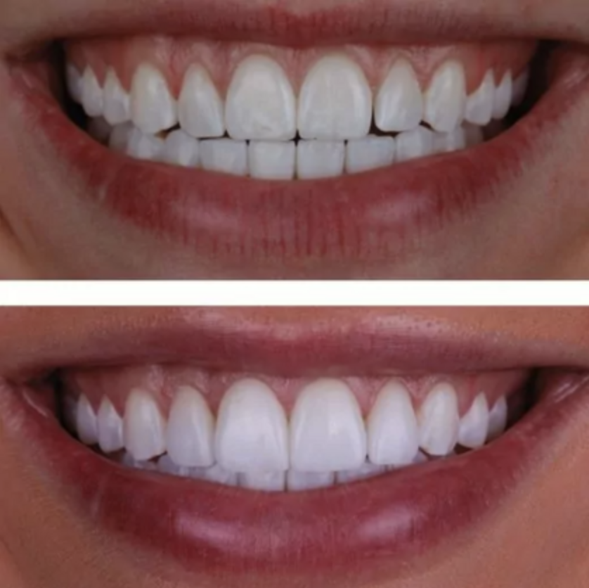 Before and after smile design