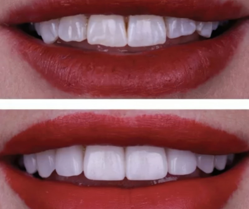 Veneers results before and after treatment