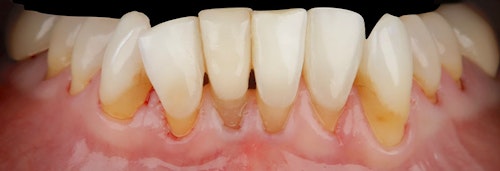 Periodontal Case 1 Before