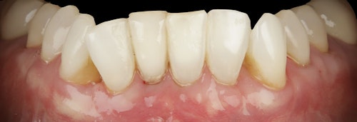 Periodontal Case After