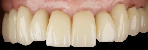 Dental Implant Case AFter