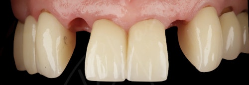 Gum Recession Case 2 Before