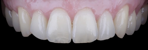 Gum Recession Case 1 After