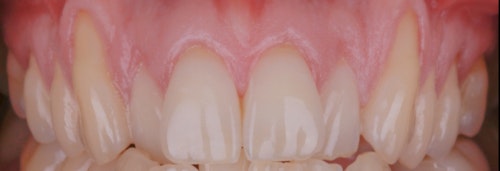 Gum Recession Case 1 Before