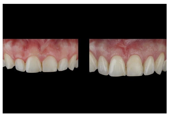 McLean gummy smile patient before and after