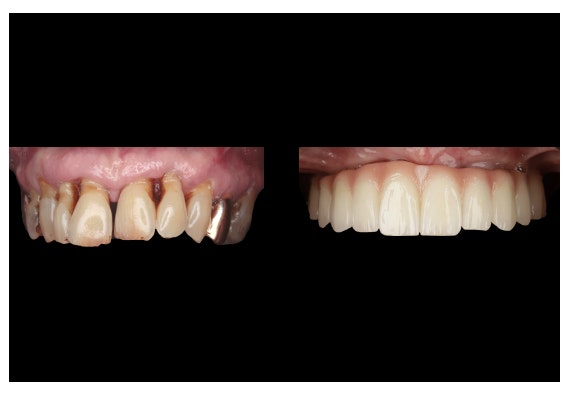 Before all-on-x treatment and after