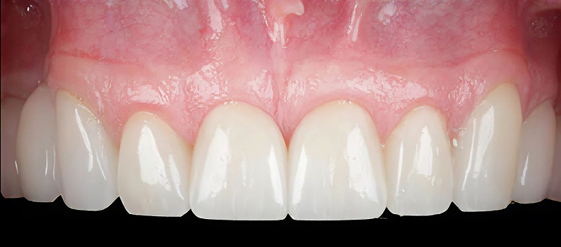 after gummy smile contouring