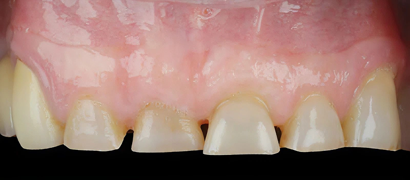 before gummy smile contouring