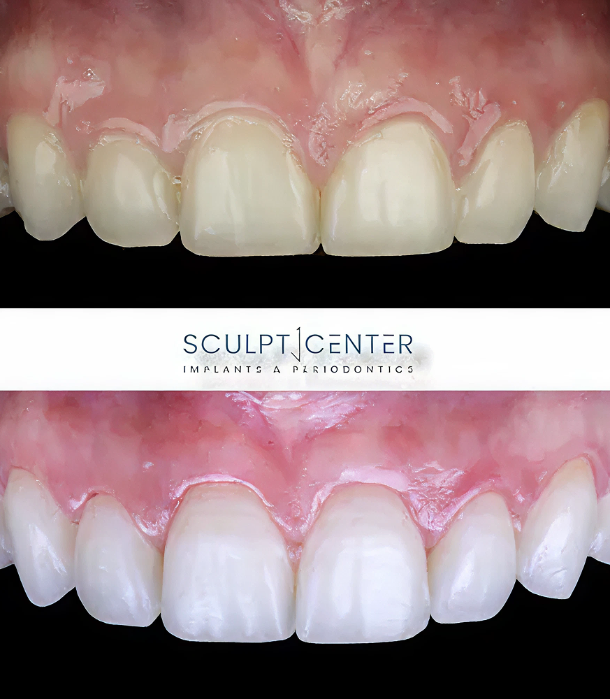 Gummy smile before and after