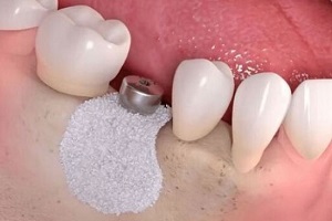 Bone Graft/Sinus Lift