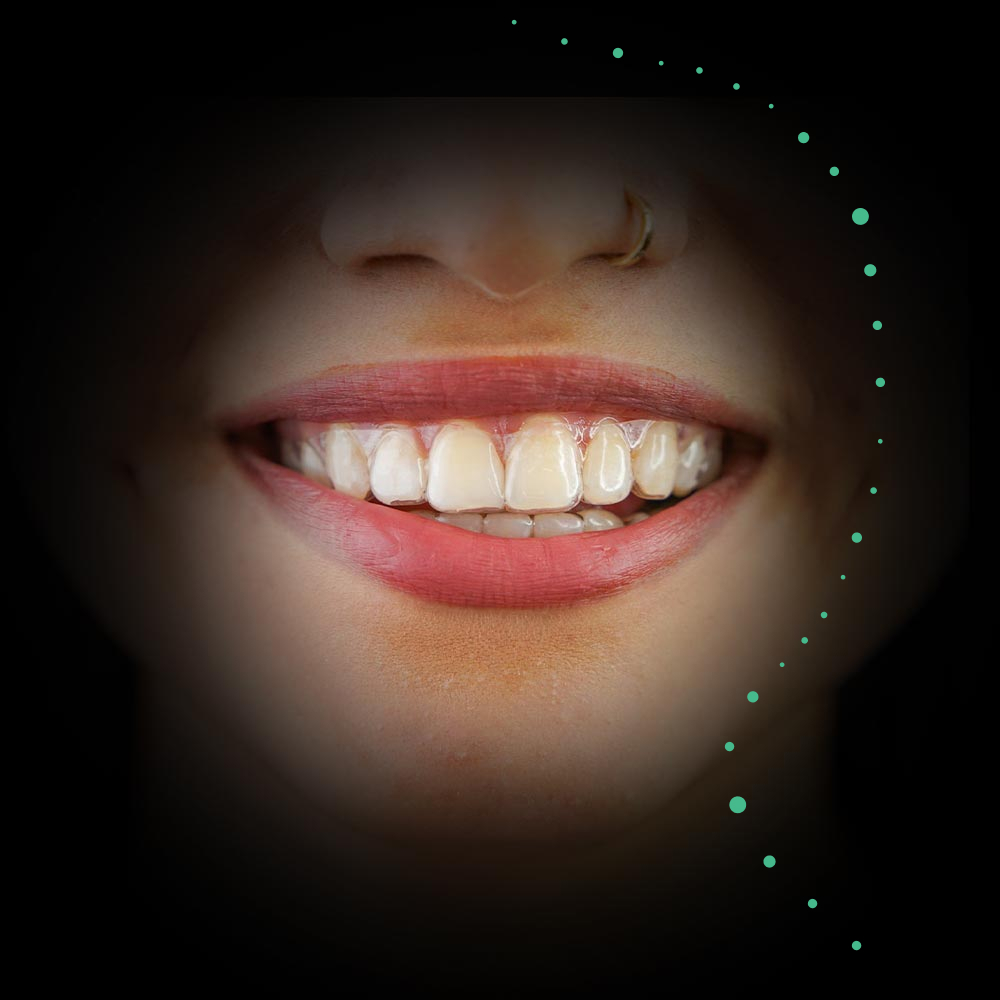 woman smiling while wearing invisalign