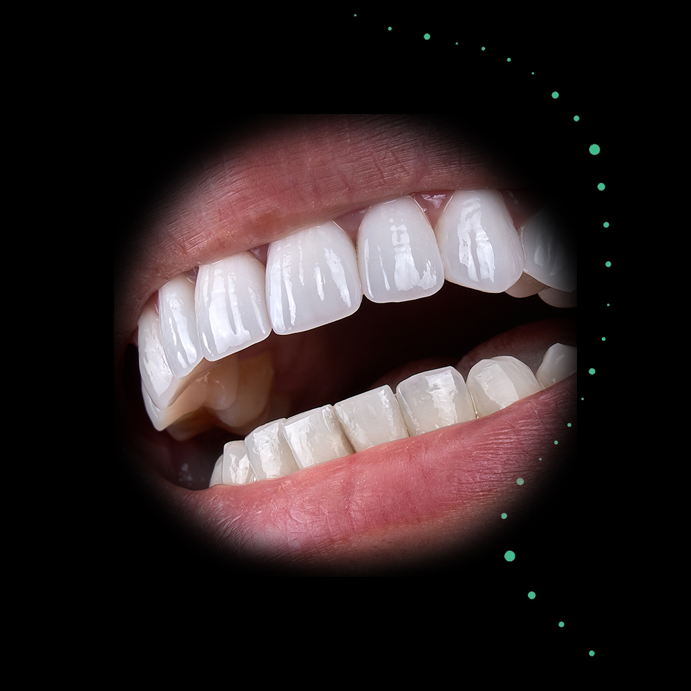 Teeth Whitening