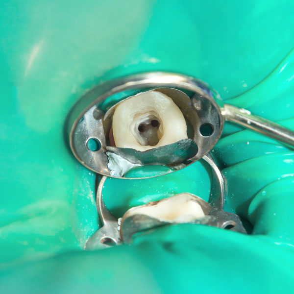 tooth being treated endodontically