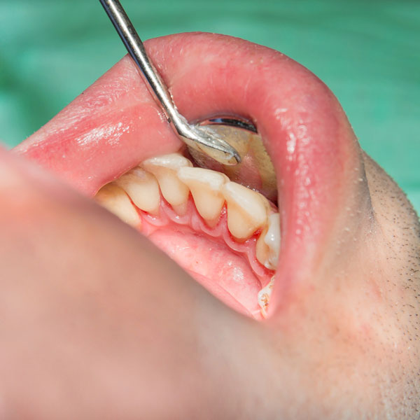 periodontal treatment
