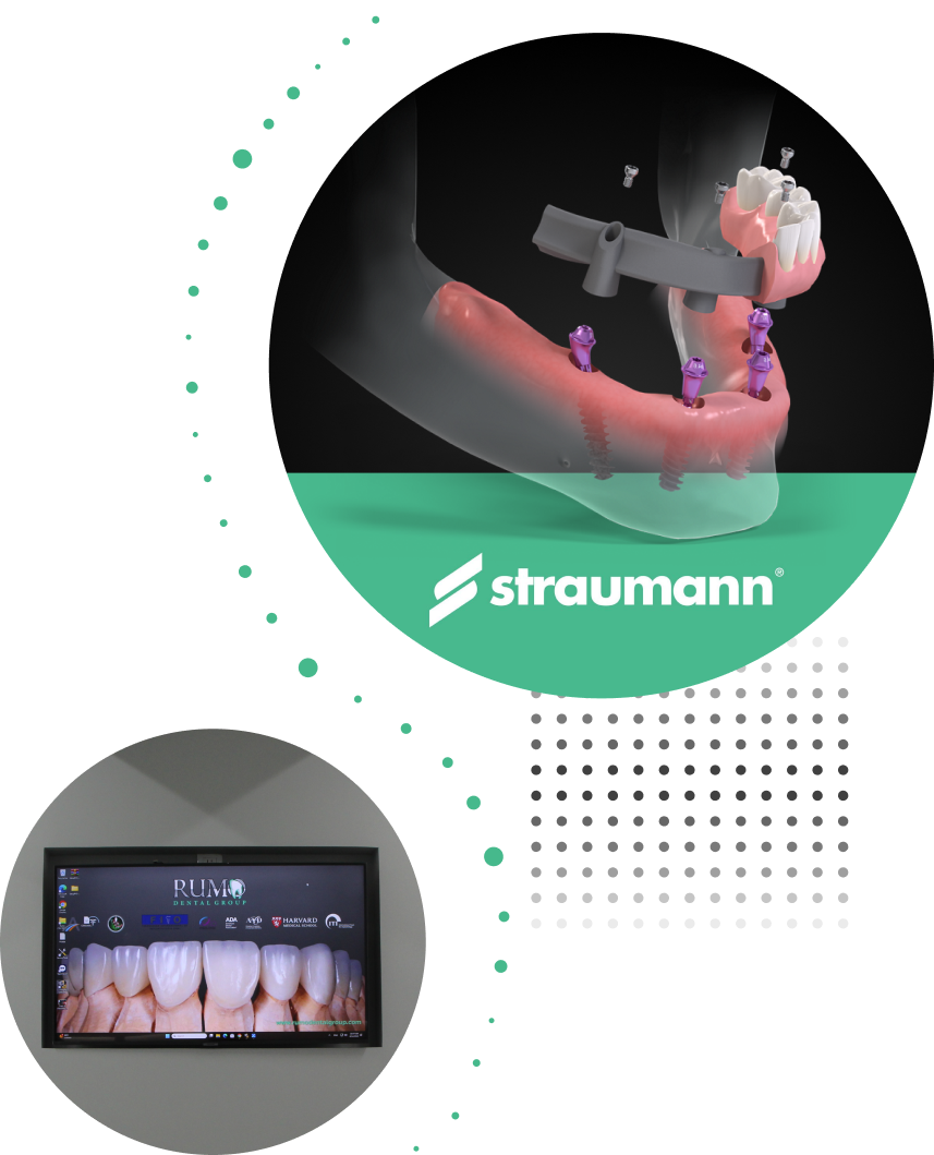 All-on-4 implant model with Straumann logo