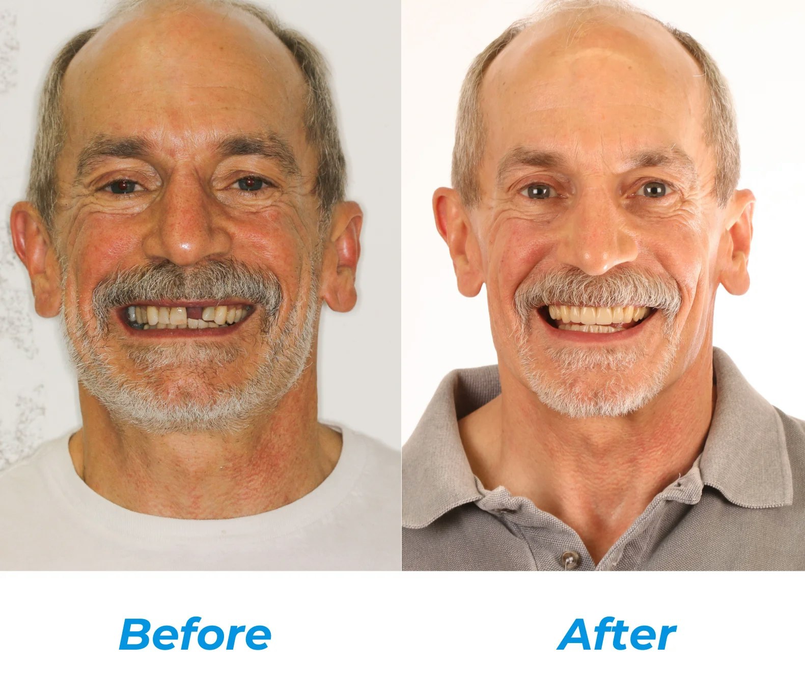 SmileOn Dental Patient Before & After