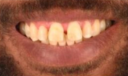 Dr. Chris Hill's STL patient with gapped, yellow teeth before cosmetic dentistry