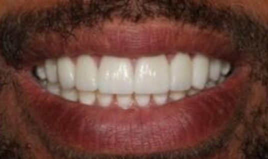 Dr. Chris Hill's patient with veneers and a beautiful smile after cosmetic dentistry treatment