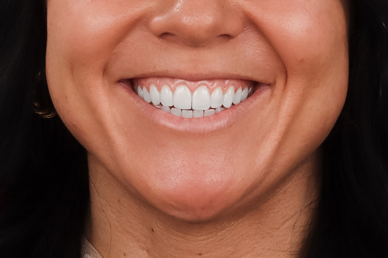 a close up of front teeth