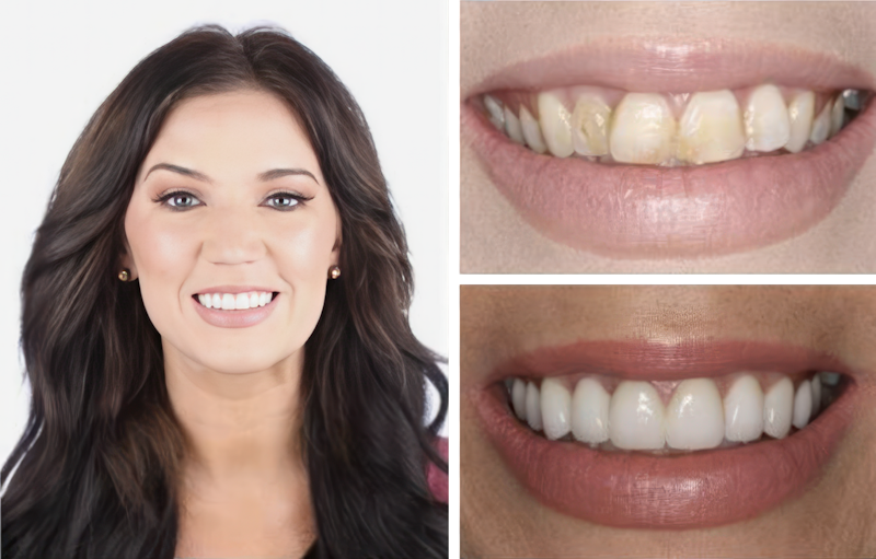 Before and After veneers