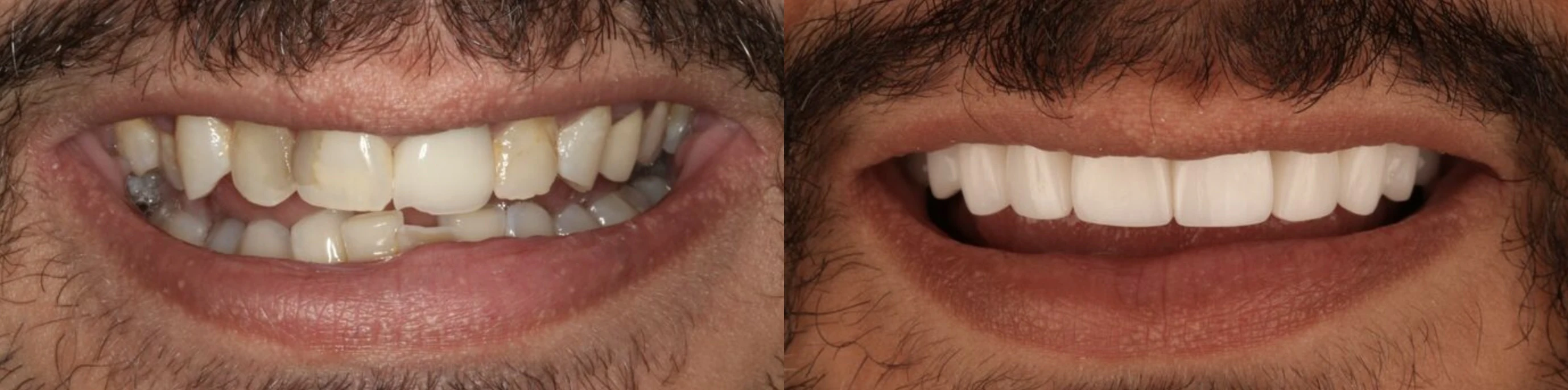 patient before and after smile makeover