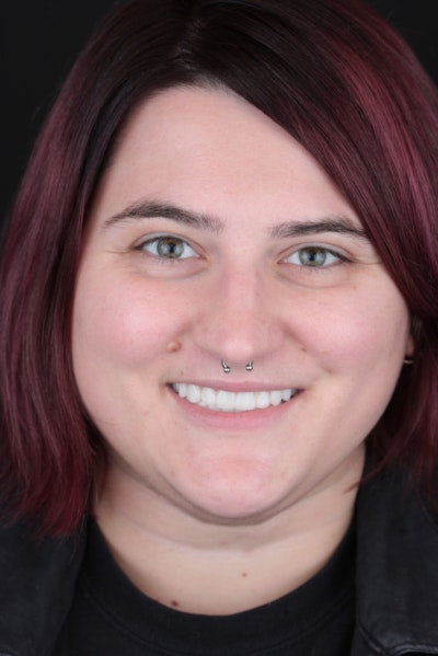 young man holding invisalign tray