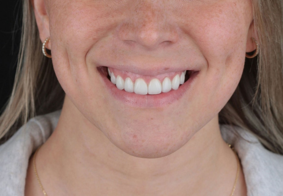 Beautiful smiling woman after cosmetic dentistry