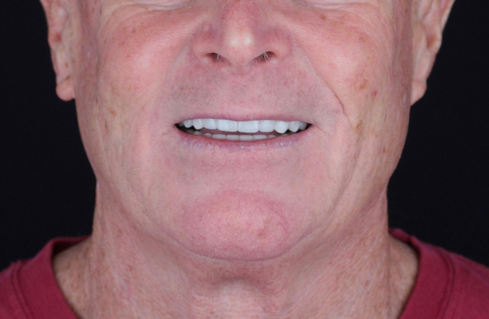 Smiling man after veneers treatment