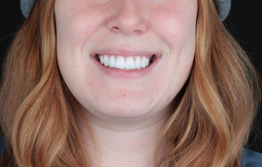 Beautiful woman after smile makeover