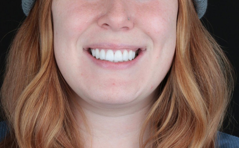 Smile makeover patient's results