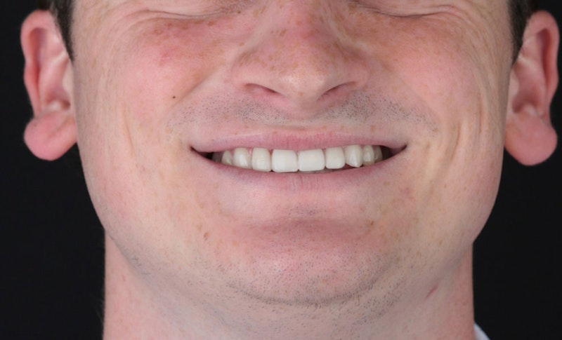smile straightened with invisalign