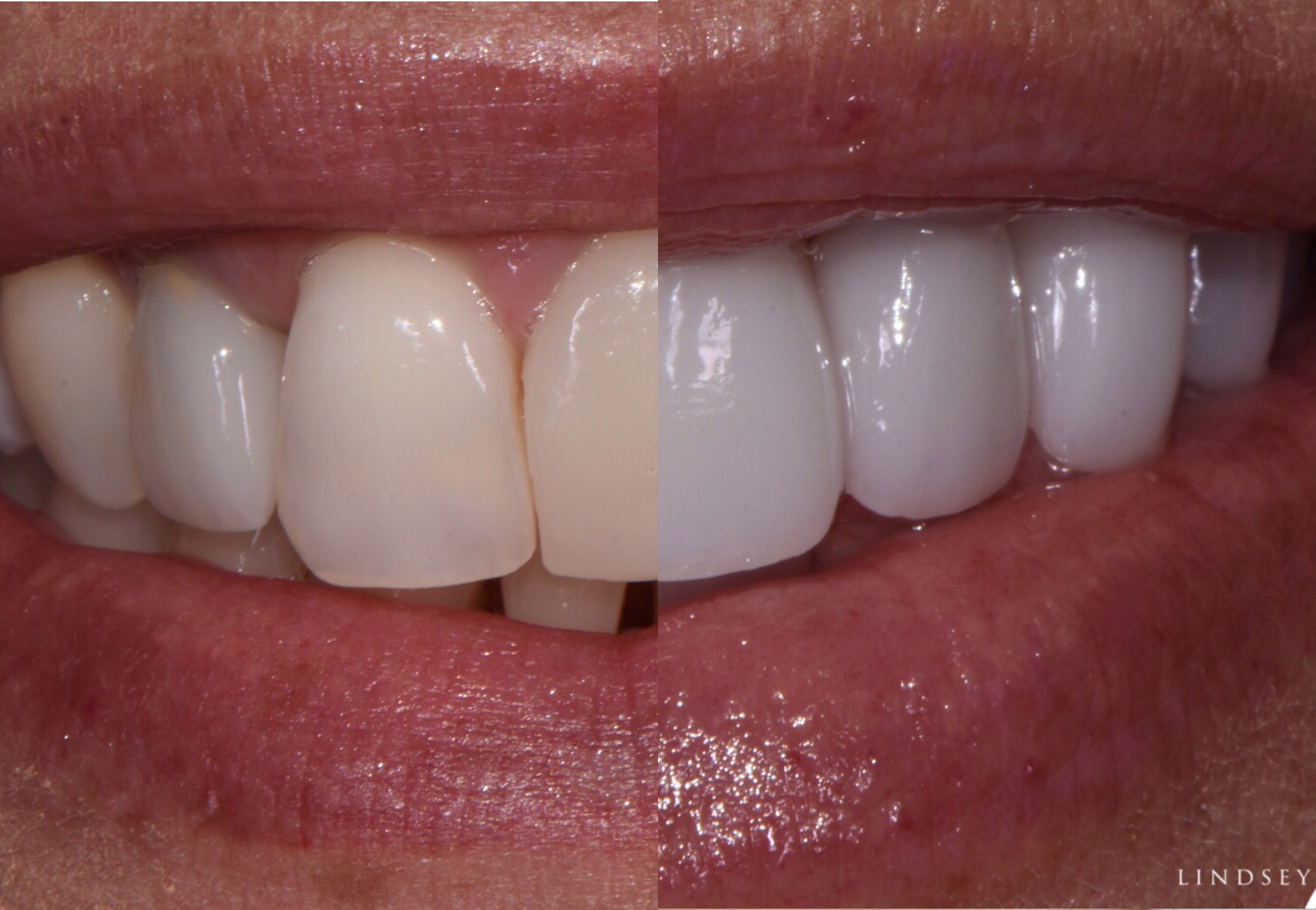 teeth whitening real result